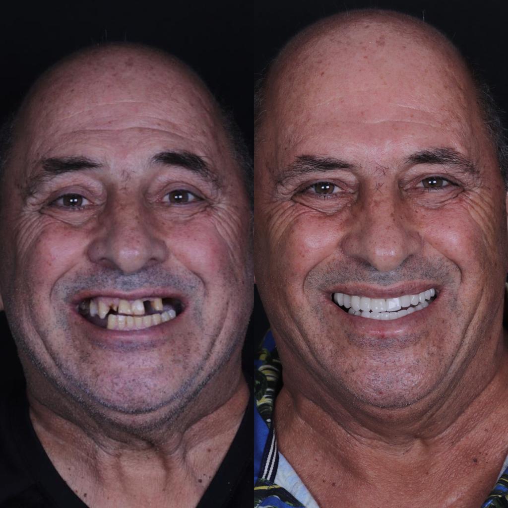 Caso real de reabilitação: antes e depois do tratamento
