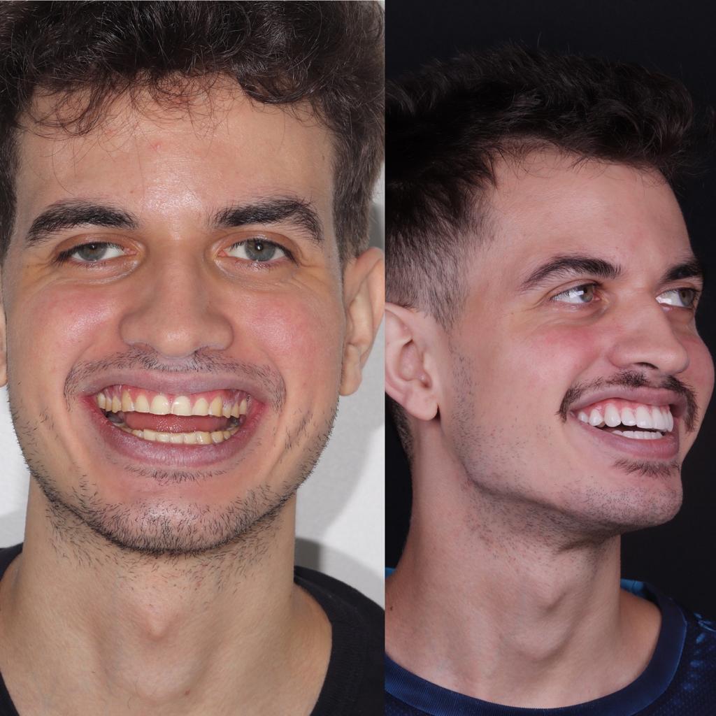 Caso real de reabilitação: antes e depois do tratamento