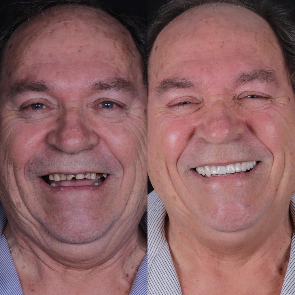 Caso real de reabilitação: antes e depois do tratamento